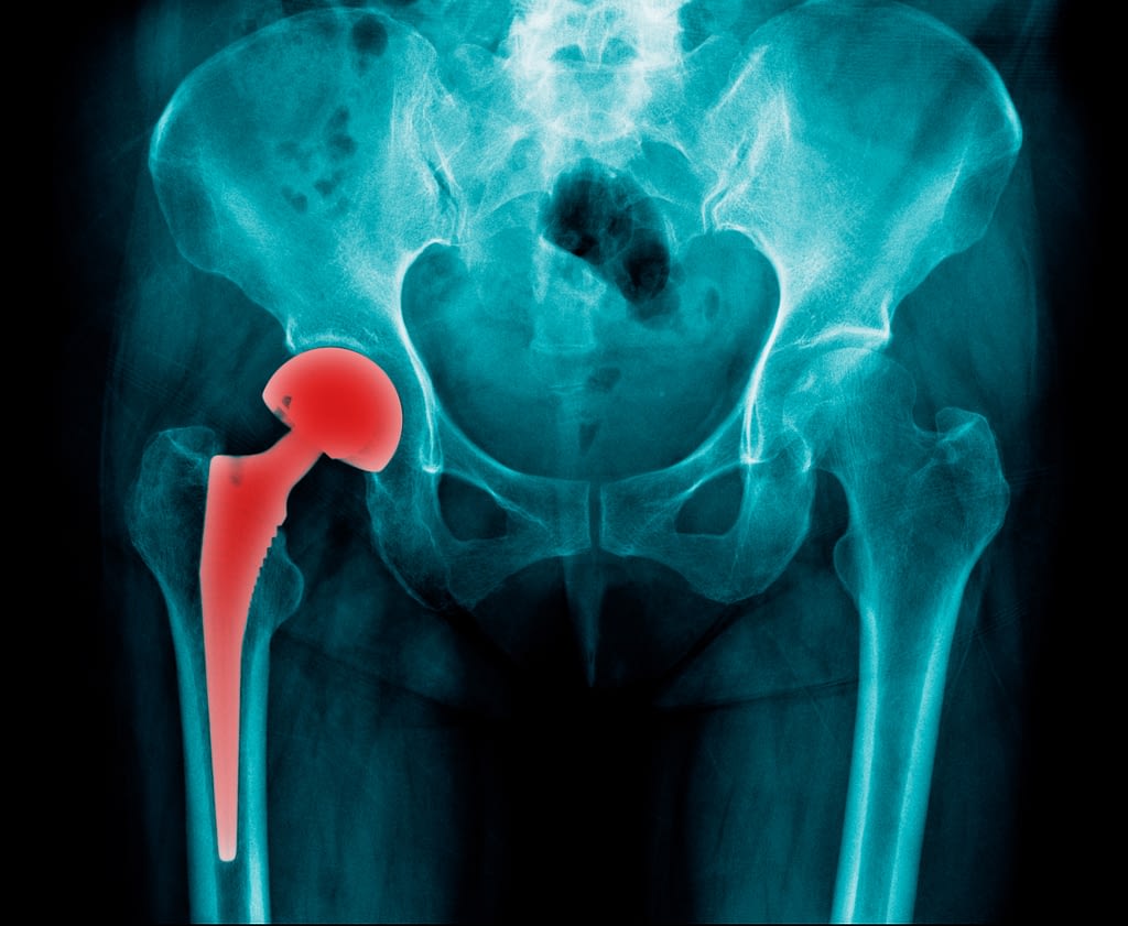 Metal on metal hip recall